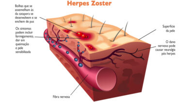 Herpes Zoster: o que é, diagnóstico e tratamento - Santé